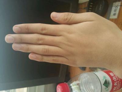 怎么样治疗冻疮效果好呢_飞华健康网