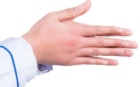 如何预防儿童冻疮呢