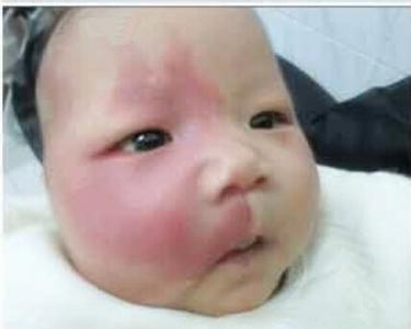 婴儿鲜红斑痣多大可以治疗