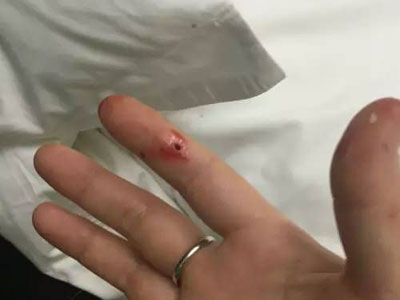 住宾馆后浑身瘙痒掀开被窝后惊呆 住宾馆后浑身瘙痒掀开被窝后惊呆