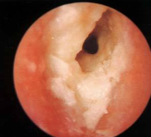 外耳道炎的早期症状都有哪些
