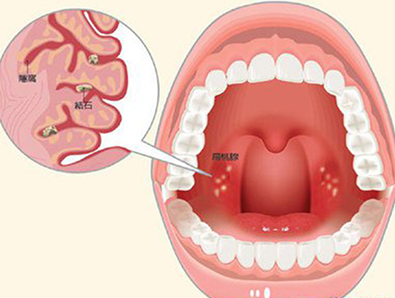 舌扁桃体肥大图片高清