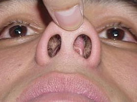 目前鼻中隔偏曲发病率越来越高了,这种疾病不仅会影响鼻子外观,还会