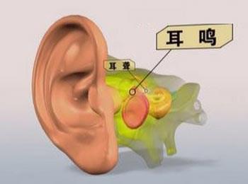 耳鸣的症状表现都有什么呢