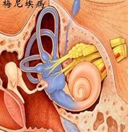 梅尼埃病到底能治愈吗