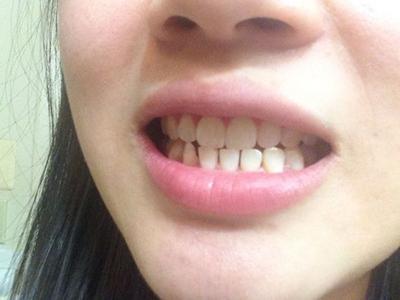 牙龈炎中医治疗的办法有哪些_飞华健康网