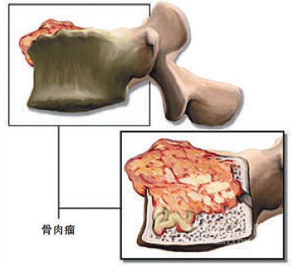 该如何预防骨肉瘤疾病复发