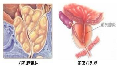 前列腺囊肿与前列腺炎一样么