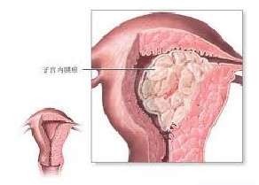 子宫内膜癌复发病例分析