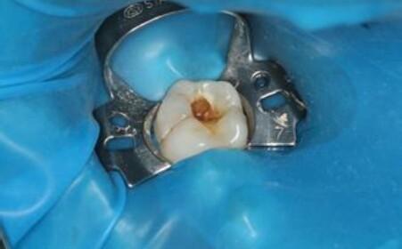 牙结石对牙齿有什么危害