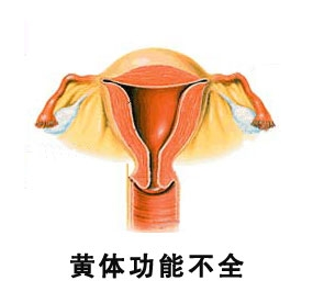 > 不孕不育 > 女性不孕 > 黄体功能不全 > 诊断