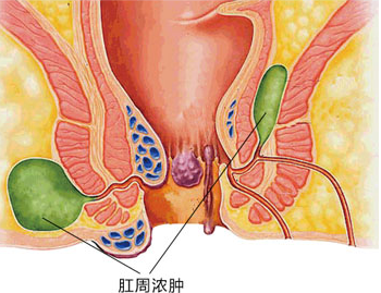 肛周脓肿有哪些检查