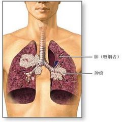 小细胞肺癌传染吗