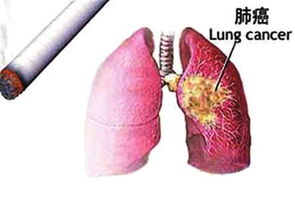 肺癌病理切片伤害大吗