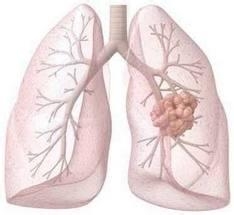 肺癌晚期能活几个月