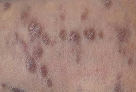 造成了皮肤黏膜受到影响,大家应该全面的认识这种疾病的特点,扁平苔藓