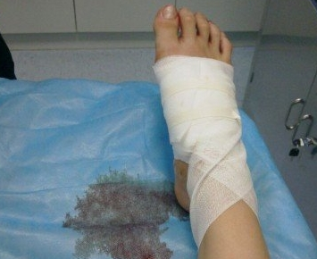 脚软组织损伤治疗方法有哪些