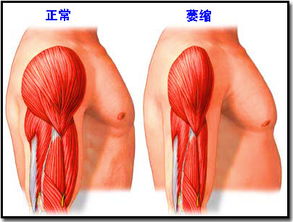 肌肉萎缩的鉴别诊断有什么