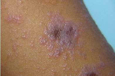 扁平苔癣是一种病变表浅,发展缓慢的皮肤粘膜病.
