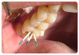 轻微的牙结石症状是什么