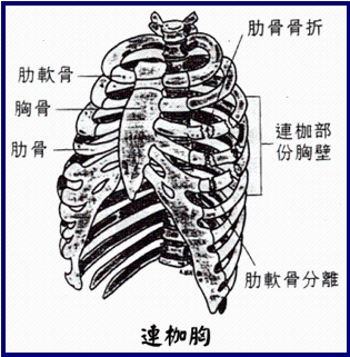 肋骨骨折如何治愈