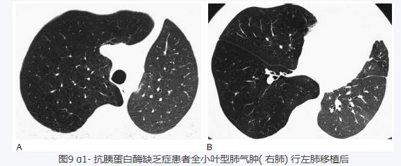 肺气肿的影像学诊断图