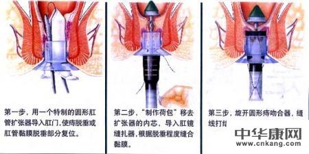 什么痔疮药效果好