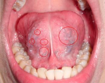 舌根口腔尖锐湿疣图片显示的症状