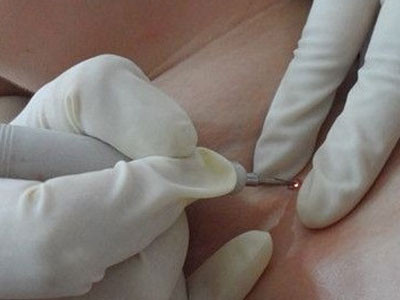 痦子和痣都能做激光手术去除吗?