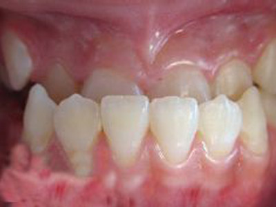 矫正牙齿地包天畸形需要做手术吗