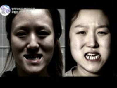 韩国地包天双胞胎矫正牙齿变美女姐妹