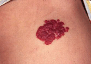 女性毛细血管瘤大多数为不高于皮面的红色斑块;二者的共同