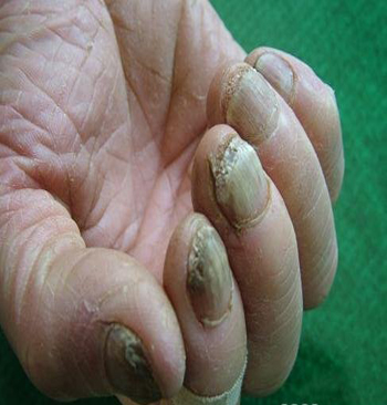 灰指甲的症状表现为几点?