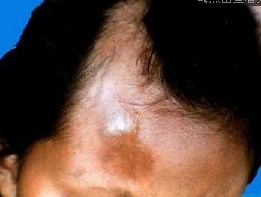 > 皮肤科 > 硬皮病 > 诊断 数周或数月之后,皮肤由肿胀期进入浸润期.
