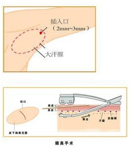 因此该手术治疗方法,只适用于严重的,经其它方法治疗效果不佳的病人