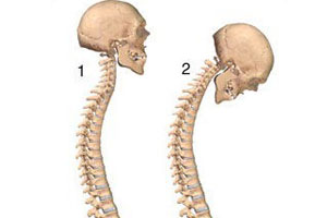 约3%强直性脊柱炎颈椎最早受累,以后下行发展至腰骶部,7%强直性脊柱炎