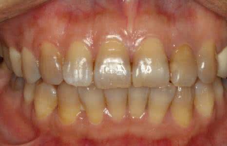 四环素牙发生的主要病因是什么