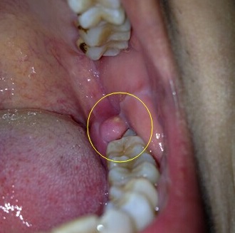 智齿是牙列中最后萌出的牙,多于18～25岁萌出,因萌出位置不足,可导致