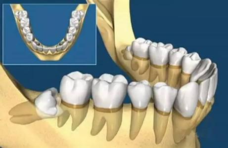 智齿冠周炎症状有哪些