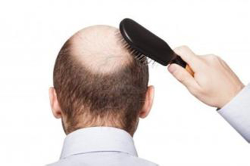 怎样正确治疗脂溢性脱发不会复发