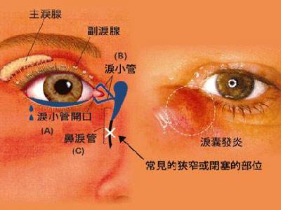 泪囊炎是什么病呢