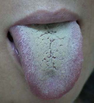 舌苔可能是疾病的信号_飞华健康网