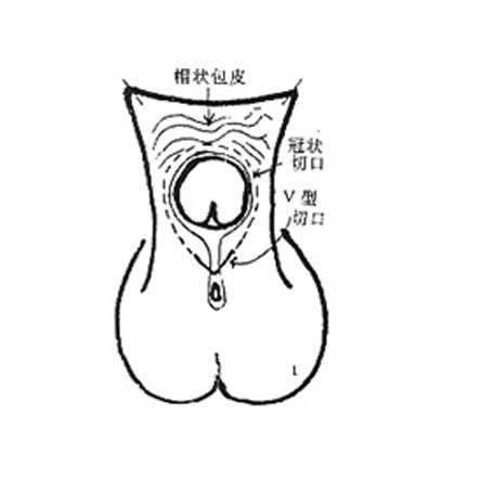 先天性尿道下裂是泌尿生殖系统常见的先天 性 疾病,手术治疗是唯一