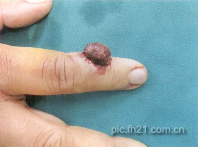 手指侧炎性肉芽肿临床表现