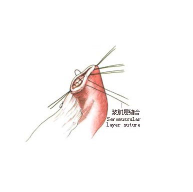 空肠食管roux-en-y吻合术