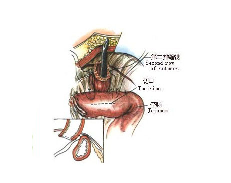 重建消化道 消化道重建有多种方式,常用的食管空肠吻合术和代胃术两种