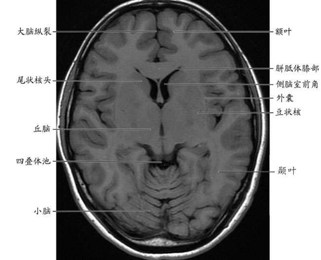 正常颅脑影像解剖图