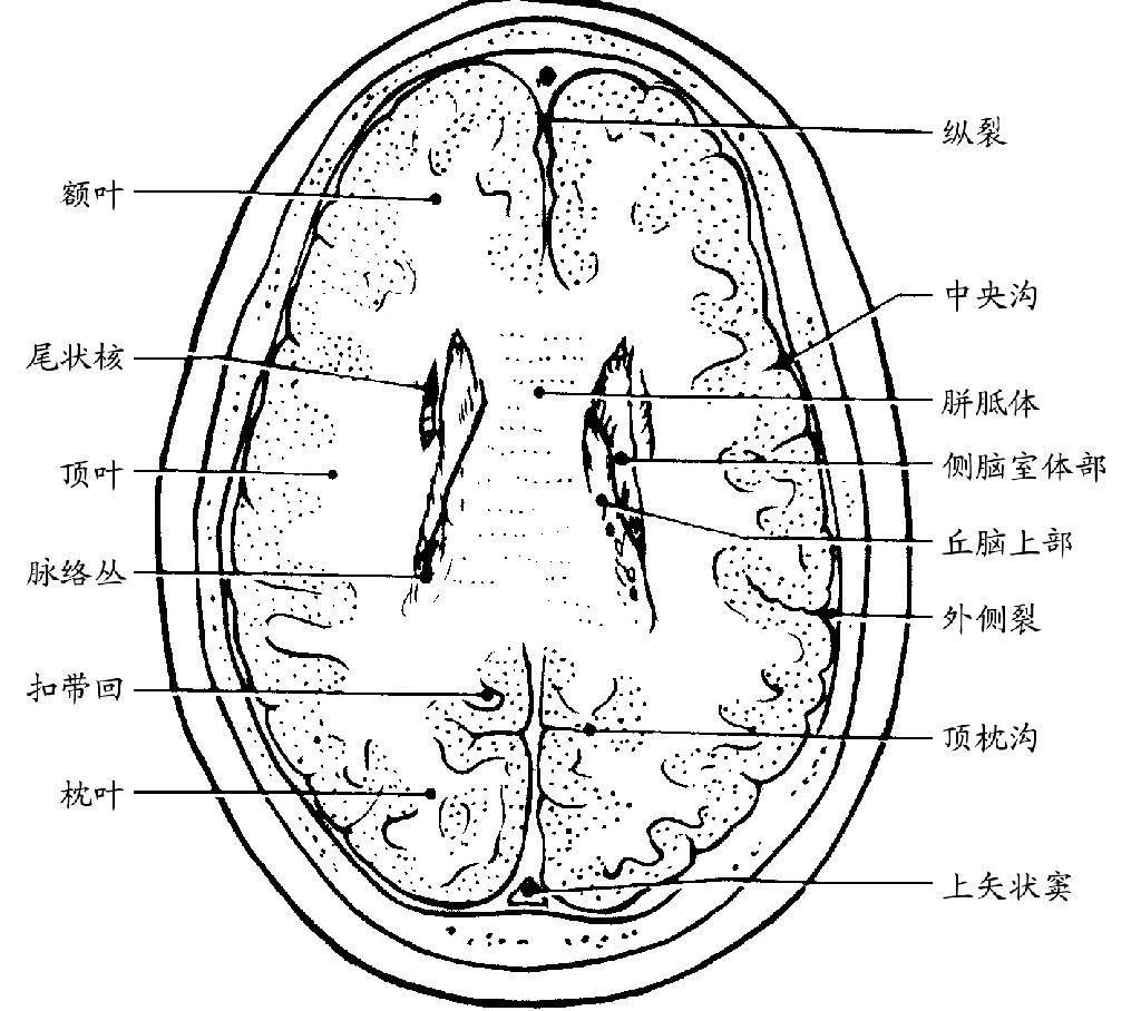 人体脑室解剖示意图