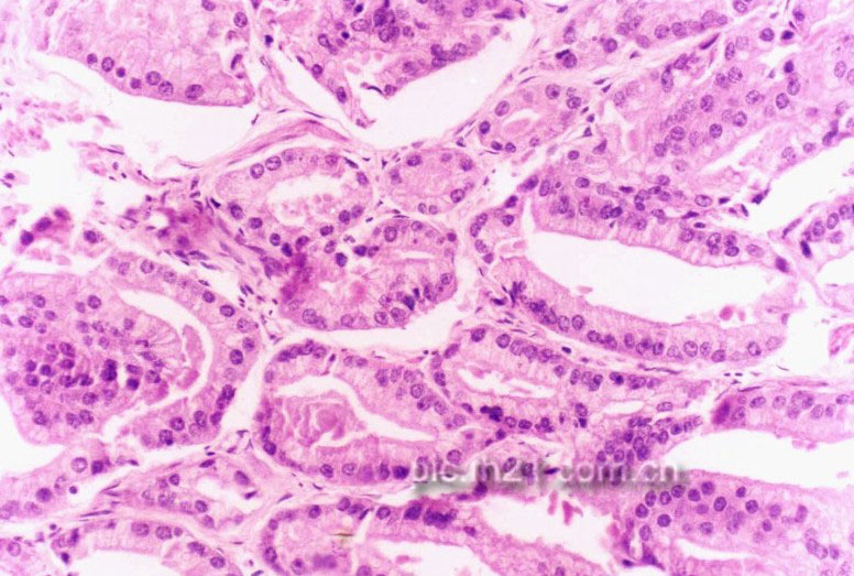 前列腺癌的病理改变图_飞华健康网