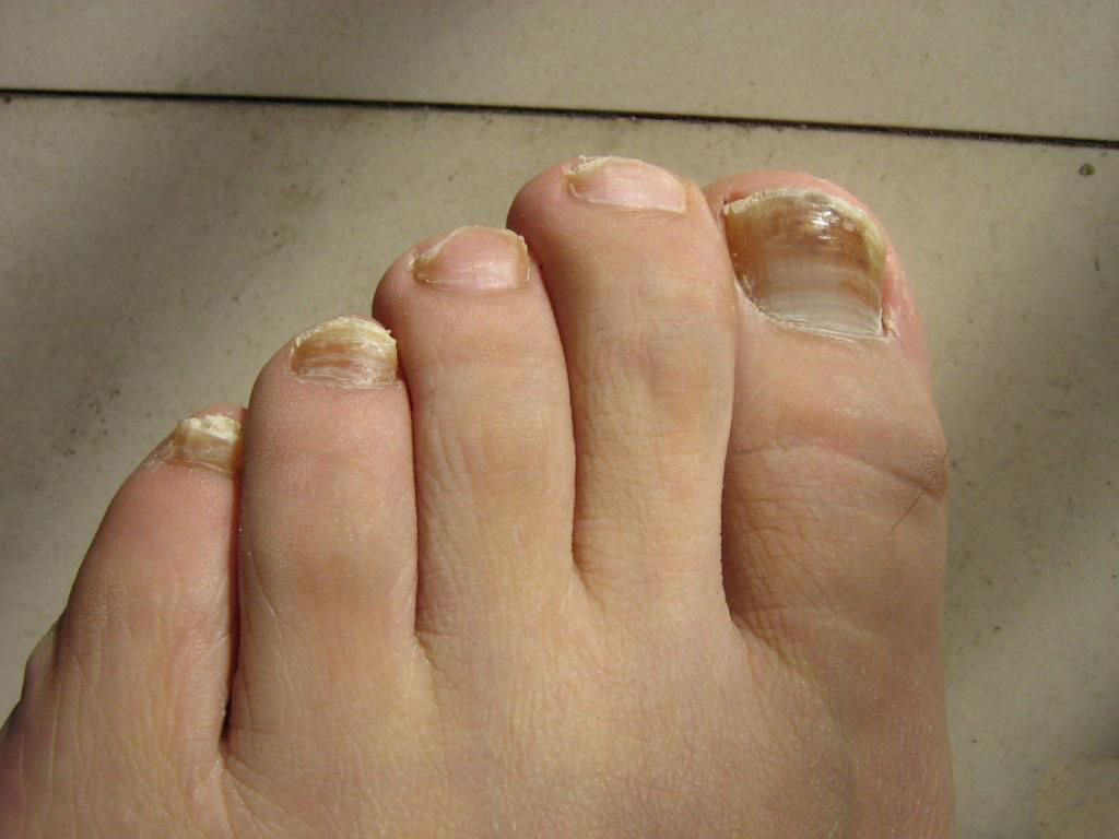 脚趾甲和健康关系密切